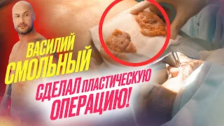 Василий Смольный СДЕЛАЛ пластическую ОПЕРАЦИЮ!