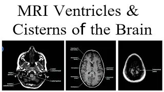 MRI ventricle and cisterns of the Brain