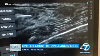 Freezing away earlier stages of breast cancer? How Cryoablation could be all a patient needs