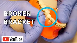 Broken Braces: Broken, Loose or Sliding Bracket| What To Do!