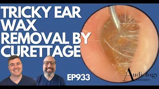 TRICKY EAR WAX REMOVAL BY CURETTAGE - EP933