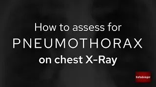 How to look for a pneumothorax on a frontal chest X-ray