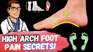 FIX High Arches & High Arch Feet [Supination & Pes Cavus Foot Type]