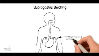 Supragastric Belching