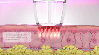 CO2 RE - фракционный лазер для шлифовки от Candela