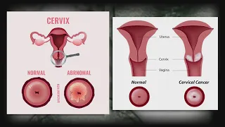 New guidelines on screening for cervical cancer