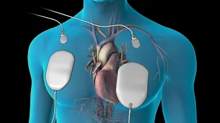 Cardioversion (for Atrial Fibrillation)