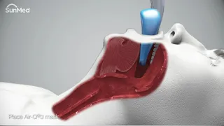 Air-Q3®Intubating Laryngeal Airways In-Service Animation