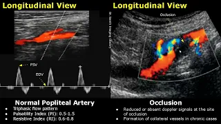 Popliteal Artery Spectral/Color Doppler Ultrasound Normal Vs Abnormal Images | Vascular USG