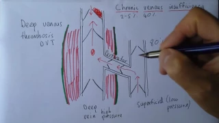 Leg Venous Disease