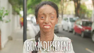 The Girl Whose Skin Peels Off | BORN DIFFERENT
