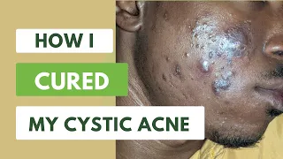 How I cured my cystic acne without help from a dermatologist