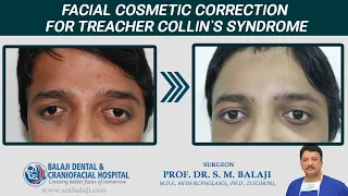 Facial Cosmetic Correction for Treacher Collin's Syndrome