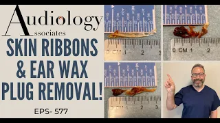 SKIN RIBBON & EAR WAX PLUG REMOVAL - EP577