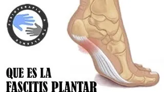 Fascitis plantar, que es y como se produce