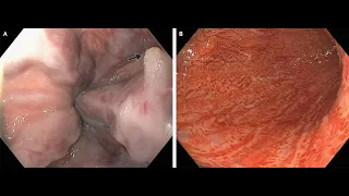 Ösophagusvarizen, "white-nipple-sign" und portale hypertensive Gastropathie