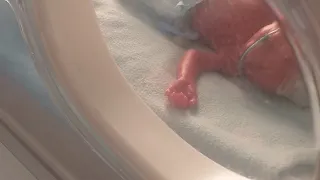 Neonatal Reflexes in a 26 Weeks Premature Baby
