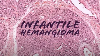 Infantile hemangioma ("Strawberry birthmark") under the microscope (pathology dermpath dermatology)