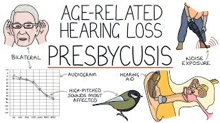 Understanding Presbycusis: Age-Related Hearing Loss