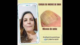 #podologia #micosenasunhas #unhasdoentes #unhas #micose #Podóloga #Podologiaemdomicílio #podologiarj