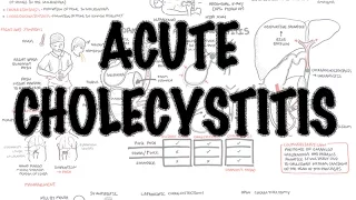 Acute Cholecystitis - Overview (signs and symptoms, pathophysiology, treatment)