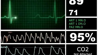 Hospital Monitor Flatline to Alive (SD)