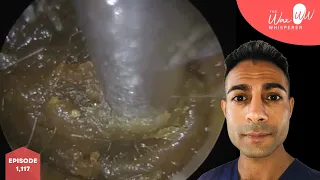 1,117 - Massive Plug of Ear Wax Removal