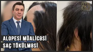 Alopesi Müalicəsi (Saç Tökülməsi) - Dermatoloq Dr. Mehdi Mahmudi #dermatoloq Tel: +994 50 519 42 19