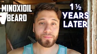 1.5 Years After Stopping Minoxidil For My Beard