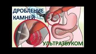 Ультразвуковое ДРОБЛЕНИЕ камней в ЖЕЛЧНОМ пузыре. БЕЗОПЕРАЦИОННЫЙ метод / Фролов Ю.А.