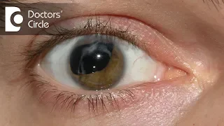 What are the causes of Cataracts? - Dr. Ajanta Chakravarty