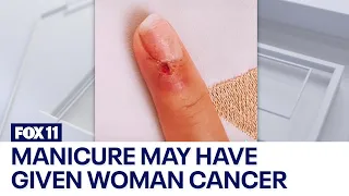 Manicure gave woman cancer under her nail, doctors believe