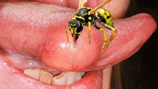 Wasp STINGS man on the tongue