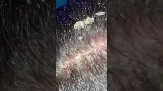 SATISFYING Dandruff Removal (Crispy Flakes)