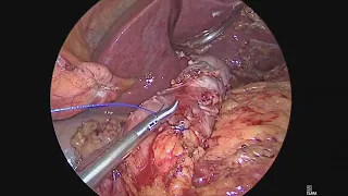 APMBSS 2023 laparoscopic gastric pouch & gastrojejunostomy anastomosis resizing with limb distalizat