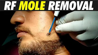 Radiofrequency Mole Removal