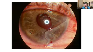 Anterior Segment Grand Rounds: Corneas, Cases, and Complexities