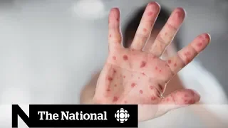 What you can do to protect your family from the measles | Health Panel