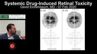Systemic-Drug Induced Retinal Toxicity - David Eichenbaum, MD - February 2020