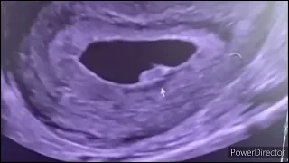 7 weeks pregnancy ultrasound//Heart beat, yolk SAC, fetal pole // week wise ultrasound series