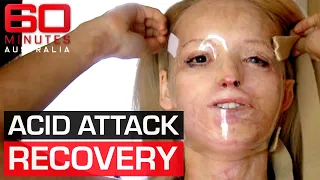 Acid attack survivor's inspirational journey to recovery | 60 Minutes Australia