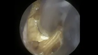 65 - Possible Canal Cholesteatoma Revealed Post Ear Wax Removal with WAXscope®️