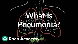 What is pneumonia? | Respiratory system diseases | NCLEX-RN | Khan Academy