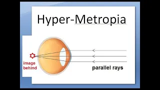 Ophthalmology 044 b HyperMetropia HyperOpia long sightedness Shot silk appearance pseudopapillitis