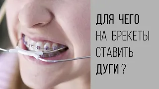 Что такое дуги на брекетах? Зачем они нужны? И зачем их менять?