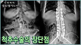 척추수술의 장단점 (KBS 20211117 방송)