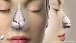 Rhinoplasty (Nose Job) Video Animation - Guncel Ozturk, MD - #DRGO