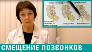 Смещение позвонков, спондилолистез поясничного отдела позвоночника - лечение