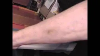 KTS Hemangioma arm bruises