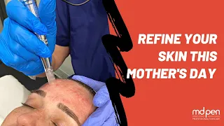 Microneedling Procedure for Moms + New Skincare Kit!